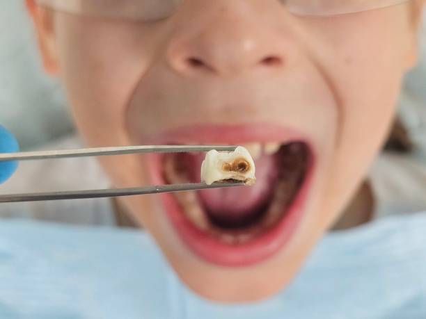 Best Emergency Broken Tooth Repair in Fitchburg, WI
